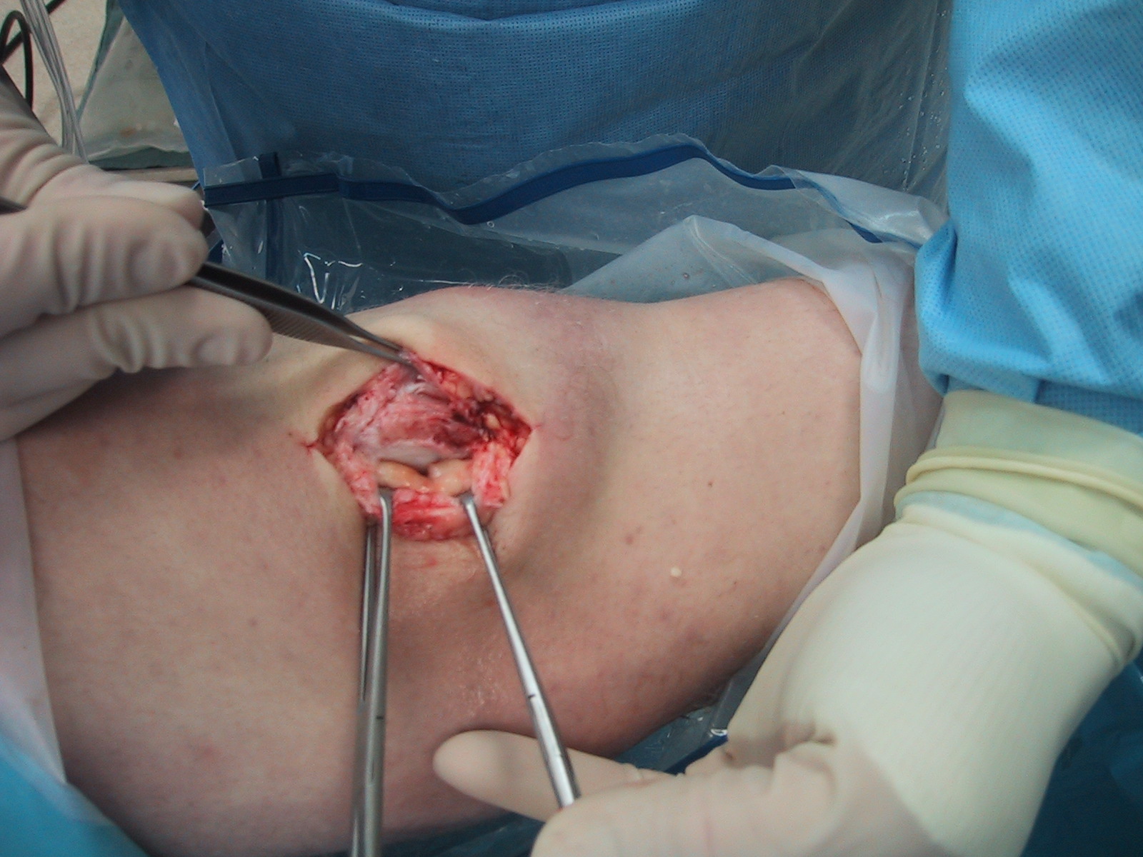 Dislocated Kneecap Treatment
