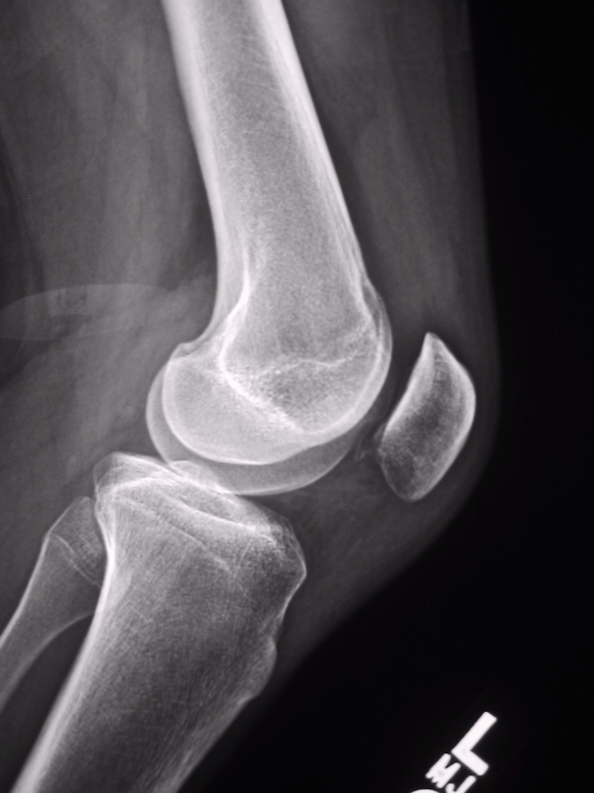 Patella Mri